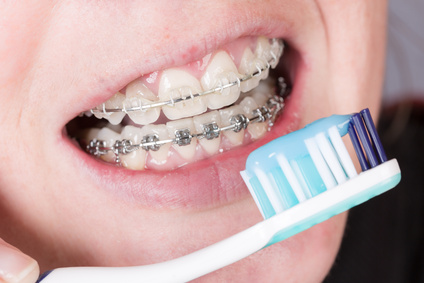 higiene dental ortodoncia