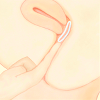 anillo vaginal como se pone