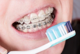 Las 5 claves de la higiene dental cuando llevas ortodoncia